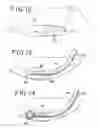 Fig. 06 - Methods and apparatus for intraocular brachytherapy
