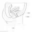 Fig. 01 - Pressure-to-tension conversion device for treating urinary incontinence