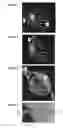 Fig. 02 -  BOLSTER FOR SECURING A SEPTAL SPLINT TO A CARDIAC WALL, A METHOD OF USE THEREOF, AND A SYSTEM INCLUDING THE SAME