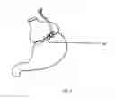 Fig. 02 - Gastric Constriction Device