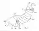 Fig. 08 - Gastric Constriction Device