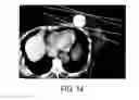 Fig. 22 - Bioabsorbable target for diagnostic or therapeutic procedure