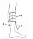 Fig. 01 - Variable length calf wrap for impulse therapy
