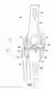 Fig. 02 - Orthotic brace
