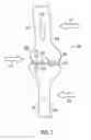 Fig. 03 - Orthotic brace