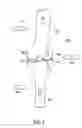 Fig. 04 - Orthotic brace