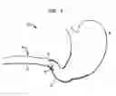 Fig. 02 - Systems and Methods for Treating of Obesity and Type 2 Diabetes