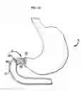 Fig. 18 - Systems and Methods for Treating of Obesity and Type 2 Diabetes