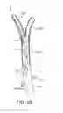 Fig. 07 - System and methods for controlling retrograde carotid arterial blood flow