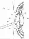 Fig. 01 - Phacoemulsification hook tip