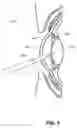 Fig. 07 - Phacoemulsification hook tip