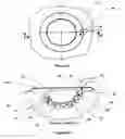 Fig. 06 - Wound cleansing apparatus with stress
