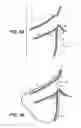 Fig. 04 - Device and methods for treating paranasal sinus conditions
