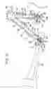 Fig. 13 - Apparatus and Method for Use With Fracture Table to Reposition Bone Portions