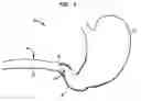 Fig. 02 - Systems and methods for treating obesity and type 2 diabetes