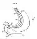 Fig. 15 - Systems and methods for treating obesity and type 2 diabetes