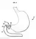 Fig. 18 - Systems and methods for treating obesity and type 2 diabetes