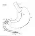 Fig. 37 - Systems and methods for treating obesity and type 2 diabetes