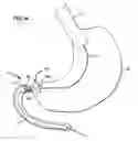 Fig. 38 - Systems and methods for treating obesity and type 2 diabetes