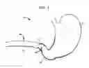 Fig. 02 - Systems and methods for treating obesity and type 2 diabetes