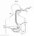 Fig. 14 - Systems and methods for treating obesity and type 2 diabetes