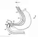 Fig. 16 - Systems and methods for treating obesity and type 2 diabetes