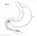 Fig. 37 - Systems and methods for treating obesity and type 2 diabetes