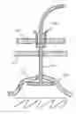 Fig. 01 - Percutaneous Gastroplasty