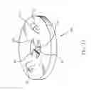 Fig. 06 - Percutaneous Gastroplasty