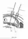 Fig. 21 - Percutaneous Gastroplasty