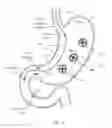 Fig. 23 - Percutaneous Gastroplasty