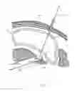 Fig. 26 - Percutaneous Gastroplasty