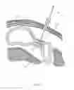 Fig. 28 - Percutaneous Gastroplasty