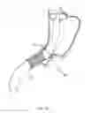 Fig. 31 - Percutaneous Gastroplasty