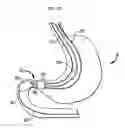 Fig. 15 - Systems and Methods for Treatment of Obesity and Type 2 Diabetes