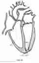 Fig. 03 - TRANSAPICAL HEART PORT