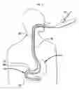Fig. 13 - Systems and Methods for Treating Obesity and Type 2 Diabetes