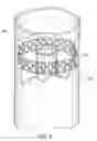 Fig. 15 - Minimal surface area contact device for holding plaque to blood vessel wall