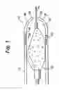 Fig. 04 - Rolled tip recovery catheter
