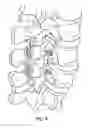 Fig. 05 - Spinal fixation system