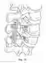 Fig. 13 - Spinal fixation system