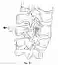 Fig. 22 - Spinal fixation system