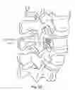Fig. 23 - Spinal fixation system