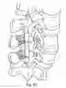 Fig. 26 - Spinal fixation system