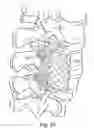 Fig. 28 - Spinal fixation system