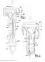Fig. 02 - Fixation device for delivery of biologic material between soft tissue and bone