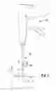 Fig. 05 - Fixation device for delivery of biologic material between soft tissue and bone