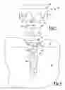 Fig. 07 - Fixation device for delivery of biologic material between soft tissue and bone
