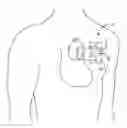 Fig. 01 - Medical device packaging system