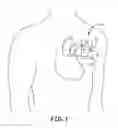 Fig. 02 - Medical device packaging system